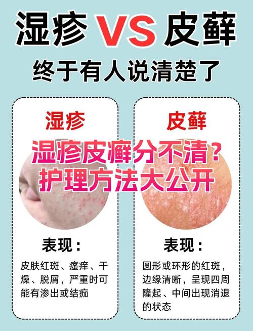 皮肤癣是什么原因造成的?