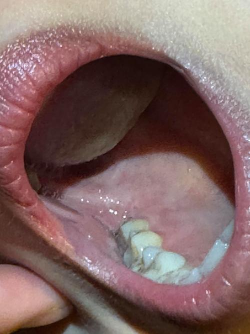 口腔上粘膜溃疡怎么办?