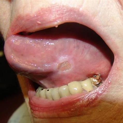 口腔上粘膜溃疡怎么办?