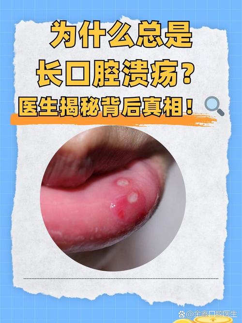 口腔溃疡属于口腔黏膜疾病吗?