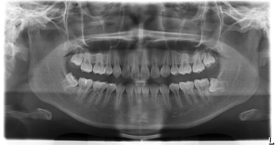 口腔全景片与CT,检查该选哪个?