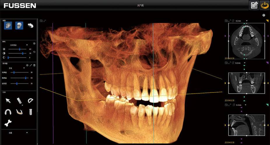 口腔全景片与CT,检查该选哪个?