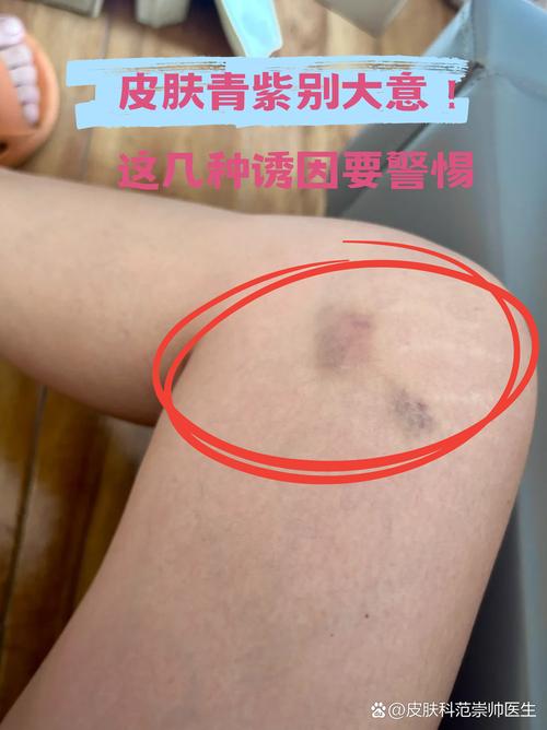 皮肤易碰青紫是何原因?
