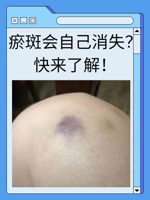 皮肤易碰青紫是何原因?