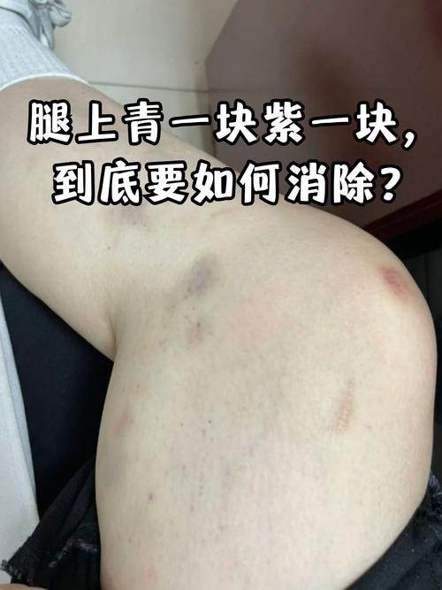 皮肤易碰青紫是何原因?