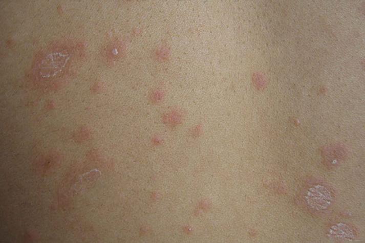 艾滋病初期皮肤症状有哪些表现?