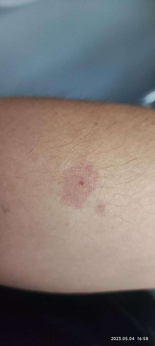 艾滋病初期皮肤症状有哪些表现?