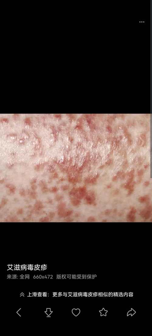 艾滋病初期皮肤症状有哪些表现?