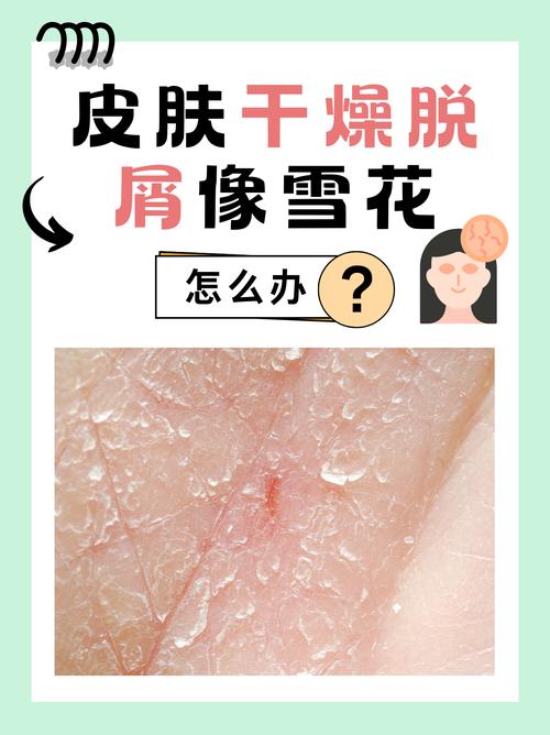 冬天皮肤干燥发痒,如何快速止痒保湿?