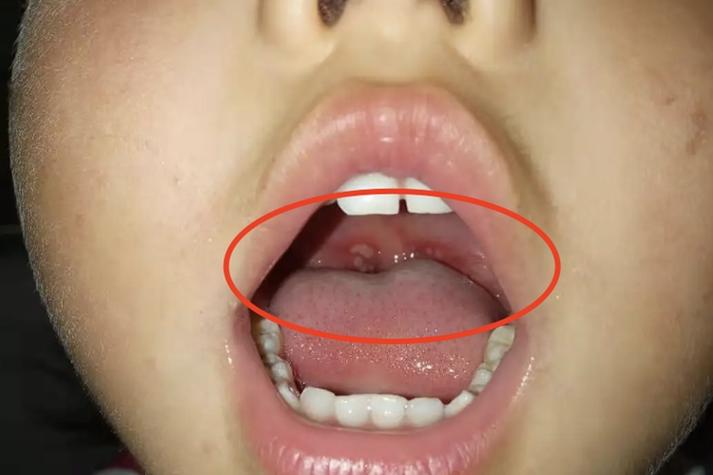 十个月宝宝口腔溃疡图怎么办?