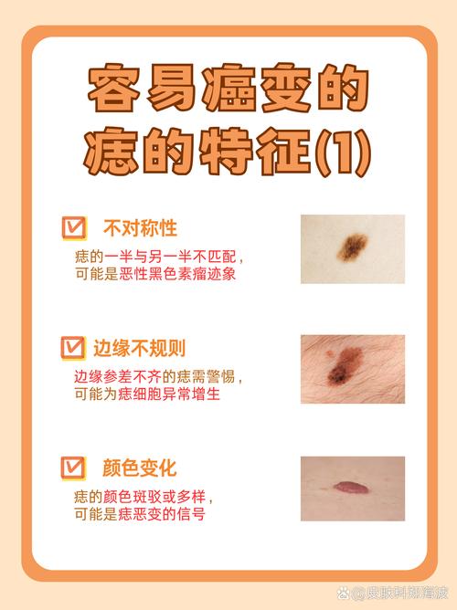 皮肤长黑点就是皮肤癌吗?