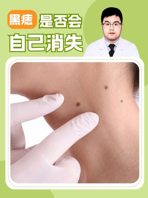 皮肤长黑点就是皮肤癌吗?