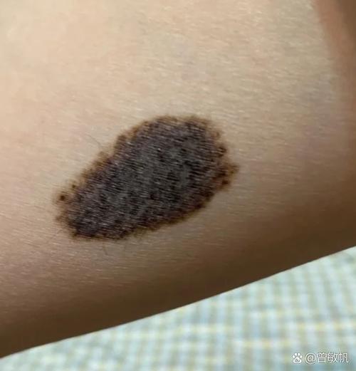 皮肤长黑点就是皮肤癌吗?