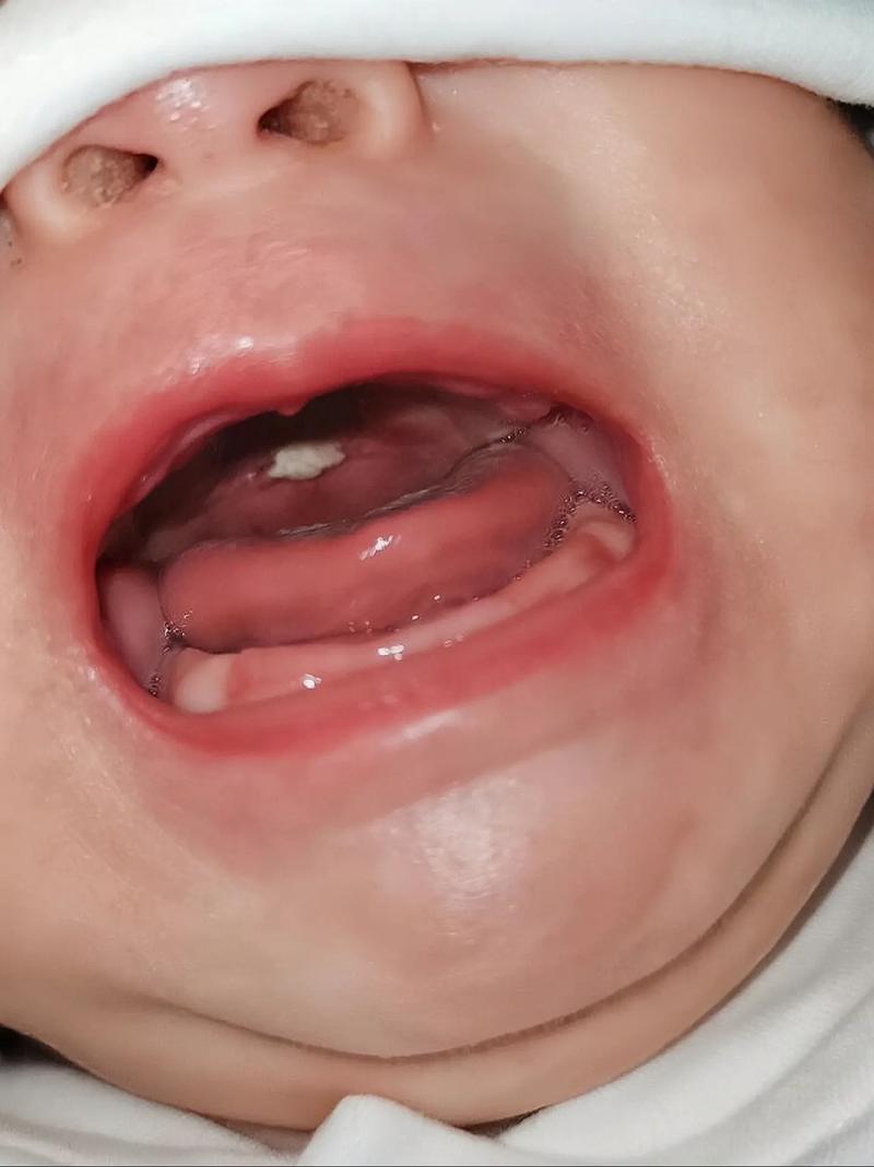 四个月宝宝口腔内照正常吗?