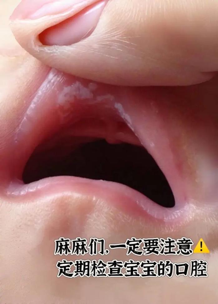 四个月宝宝口腔内照正常吗?