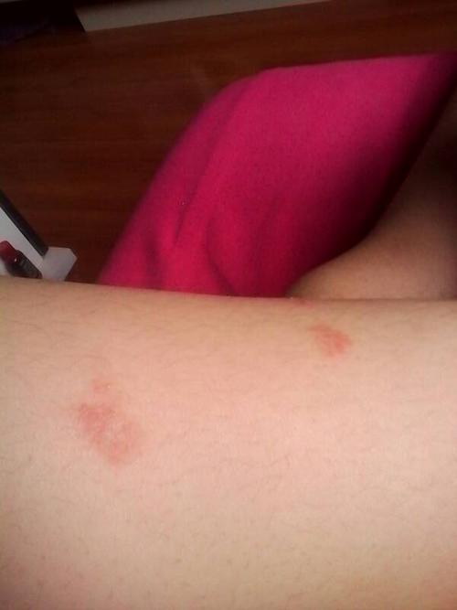 皮肤红粒痒是过敏还是其他问题?