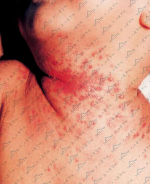 皮肤红粒痒是过敏还是其他问题?