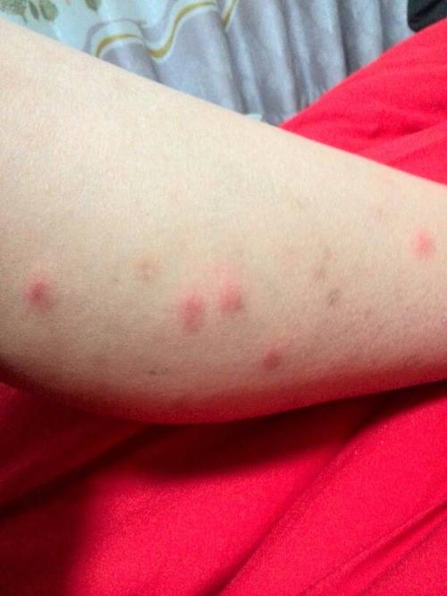 皮肤红粒痒是过敏还是其他问题?