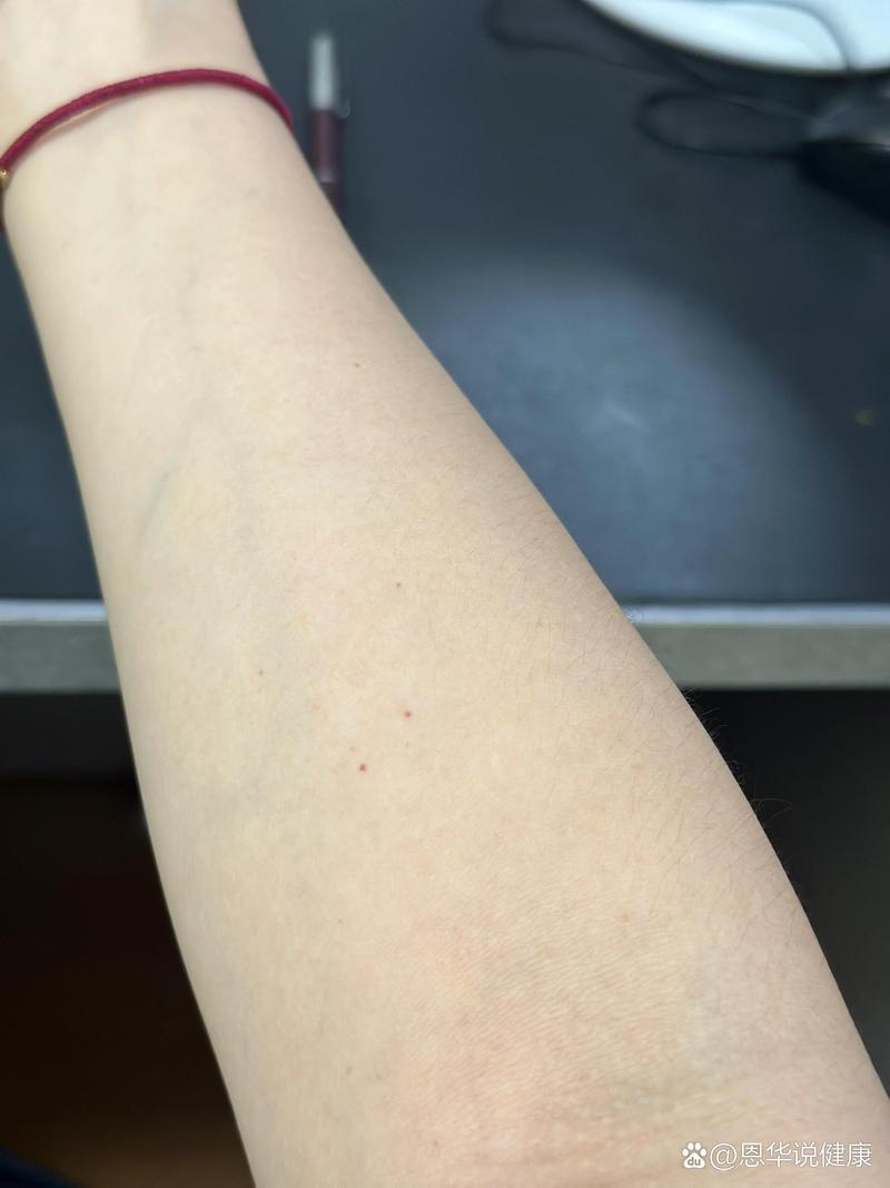 皮肤小红点像血点,是啥问题?