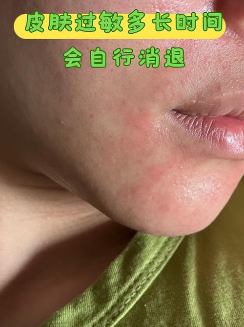 皮肤过敏能用马油吗?