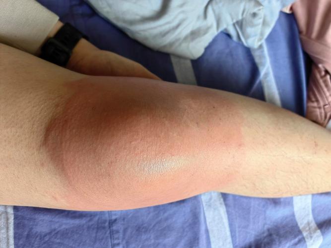 贴膏药皮肤痒正常吗?