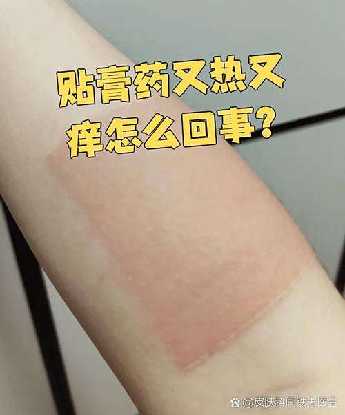 贴膏药皮肤痒正常吗?