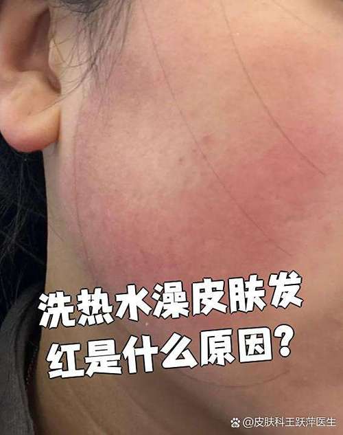 皮肤过敏洗热水澡会加重吗?