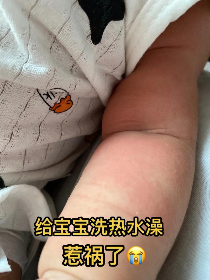 皮肤过敏洗热水澡会加重吗?