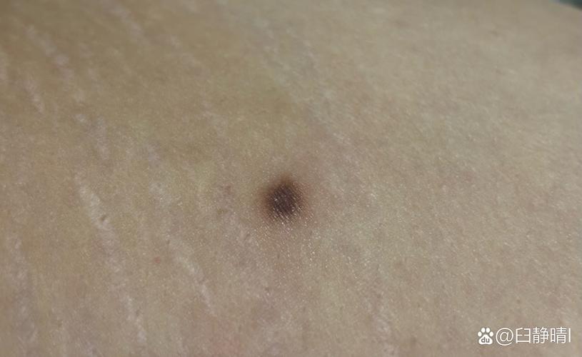 皮肤长小黑点越来越多