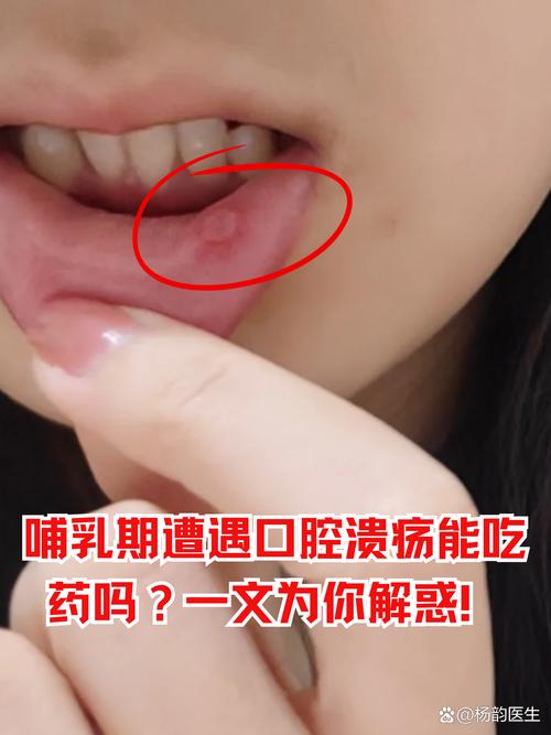 漱口腔内壁疼,是漱口水的错吗?