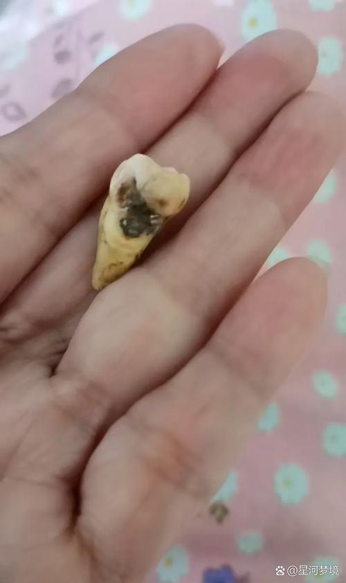 拔牙6天洞里食物残渣怎么办?