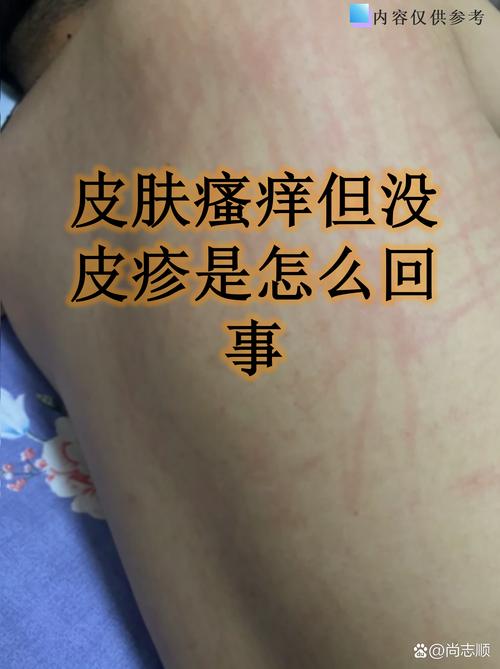 季节皮肤痒,咋办?