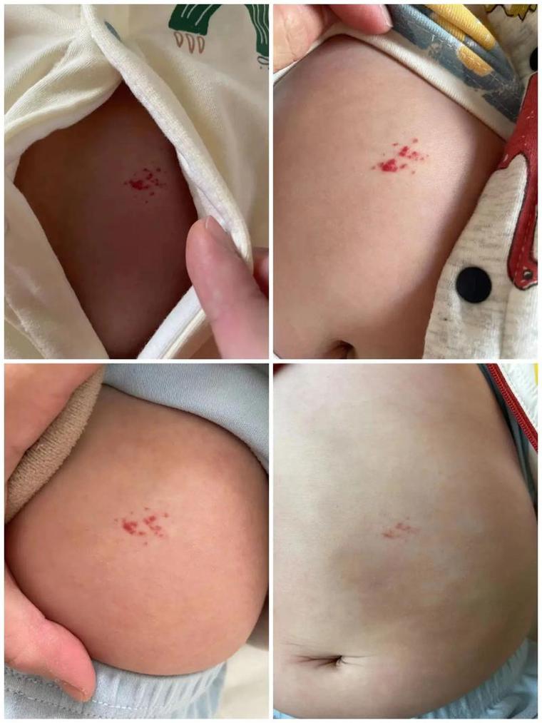 新生儿皮肤发红是正常现象吗?