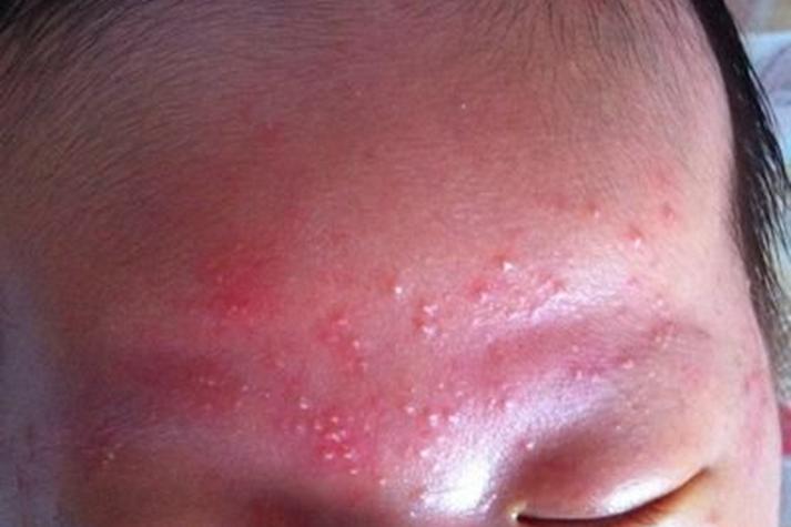 新生儿皮肤发红是正常现象吗?