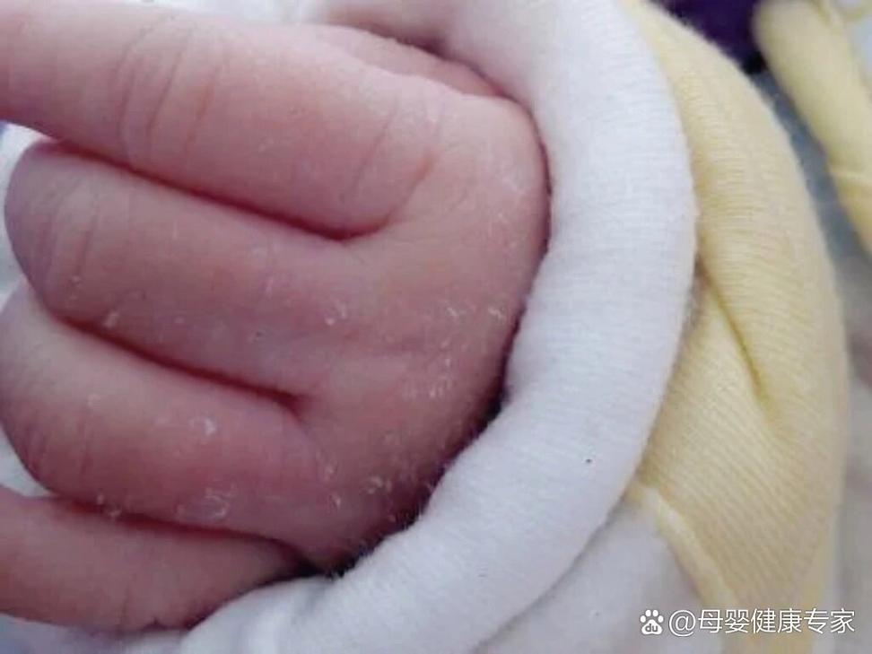 新生儿皮肤发红是正常现象吗?