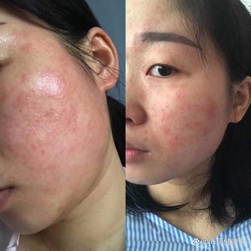 脸上皮肤过敏症状图片