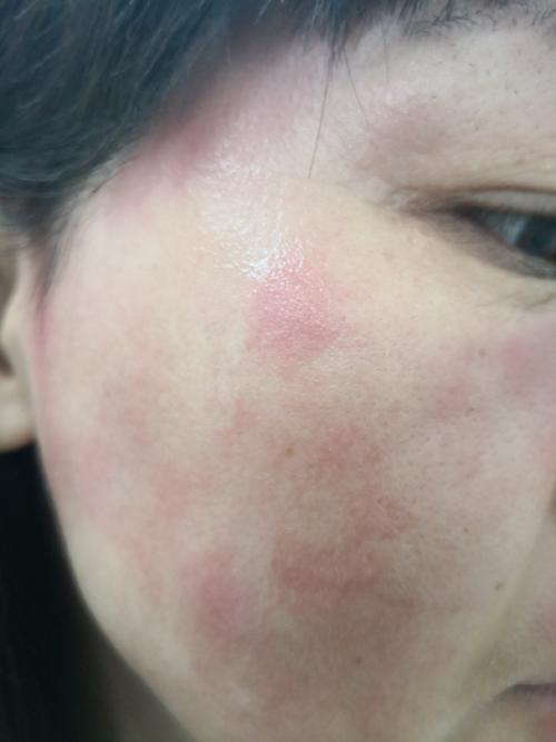 脸上皮肤过敏症状图片