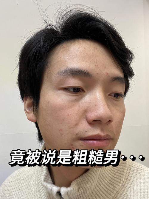 男油皮怎么改善?控油保湿还是换护肤品?