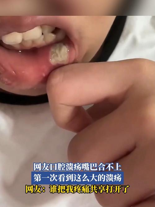 口腔溃疡为何好多天都不好?