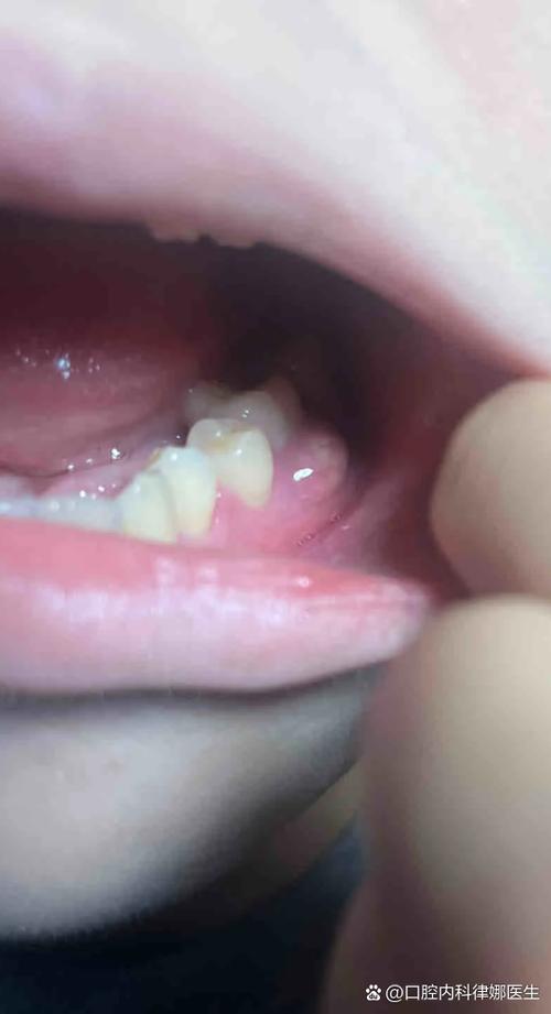 口腔最后面的牙是智齿还是其他问题?