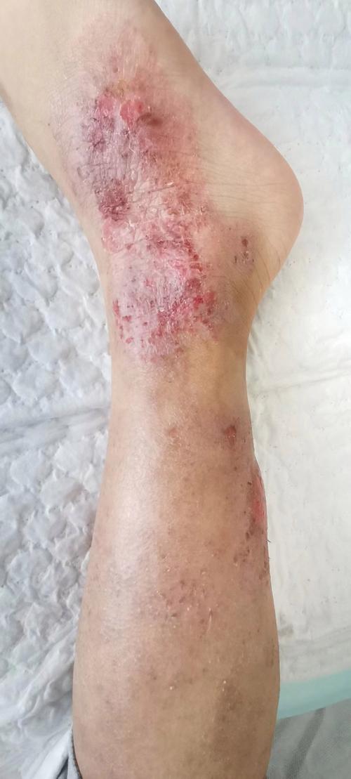 湿毒引起的皮肤病图片