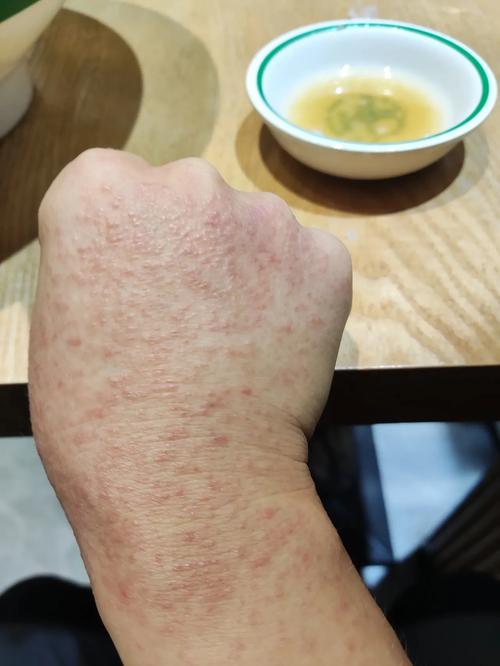 湿毒引起的皮肤病图片