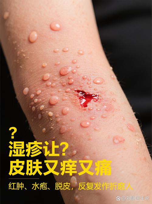 湿毒引起的皮肤病图片