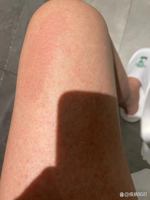 洗完澡皮肤痒起红疙瘩