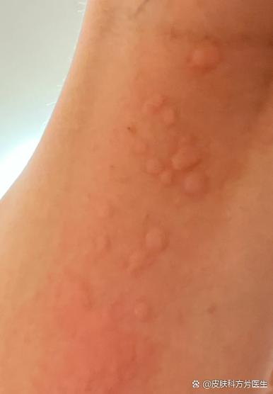 洗完澡皮肤痒起红疙瘩