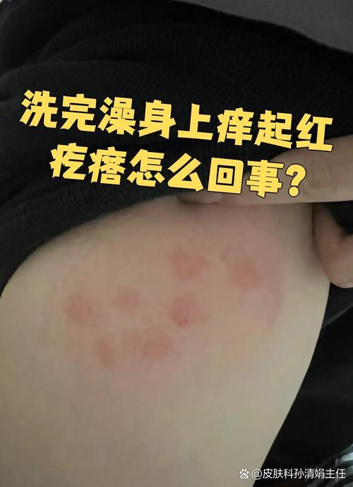 洗完澡皮肤痒起红疙瘩
