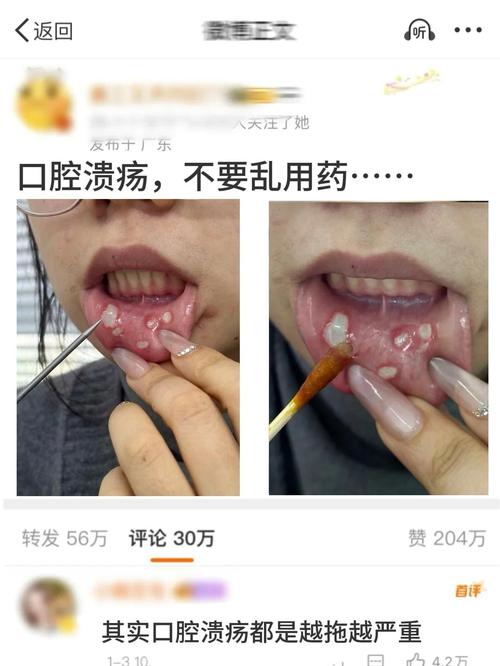嗓子疼口腔溃疡怎么办?