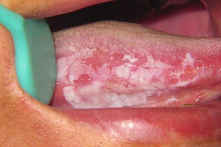 口腔内壁发白有条线是啥原因?