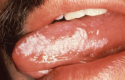 口腔内壁发白有条线是啥原因?