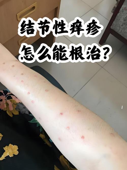 吃结核药皮肤痒是否正常?